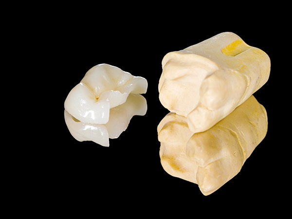 セラミックの詰め物など白い詰め物