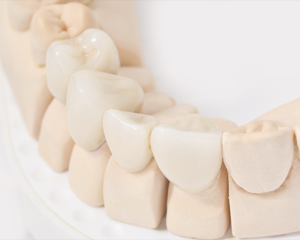 前歯(糸切り歯より前)のクラウン(被せ物)