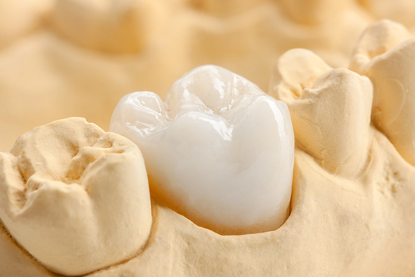 奥歯(第一小臼歯以後)のクラウン(被せ物)